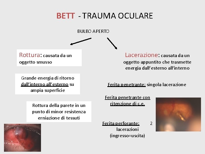 BETT - TRAUMA OCULARE BULBO APERTO Rottura: causata da un oggetto smusso Grande energia