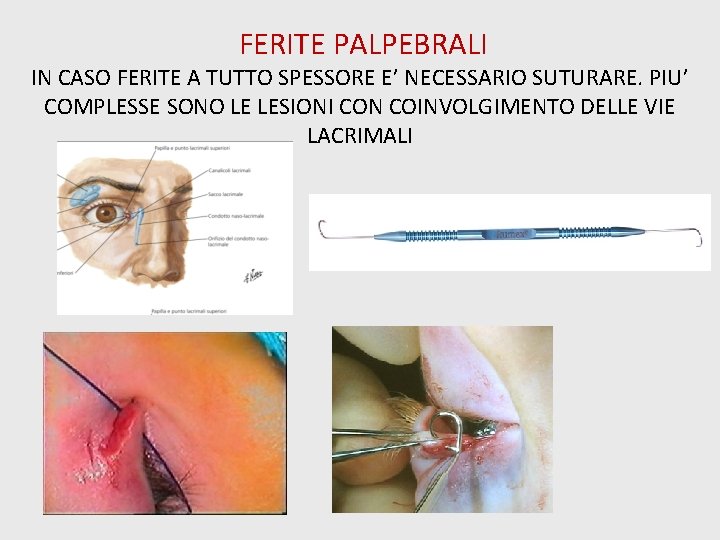 FERITE PALPEBRALI IN CASO FERITE A TUTTO SPESSORE E’ NECESSARIO SUTURARE. PIU’ COMPLESSE SONO