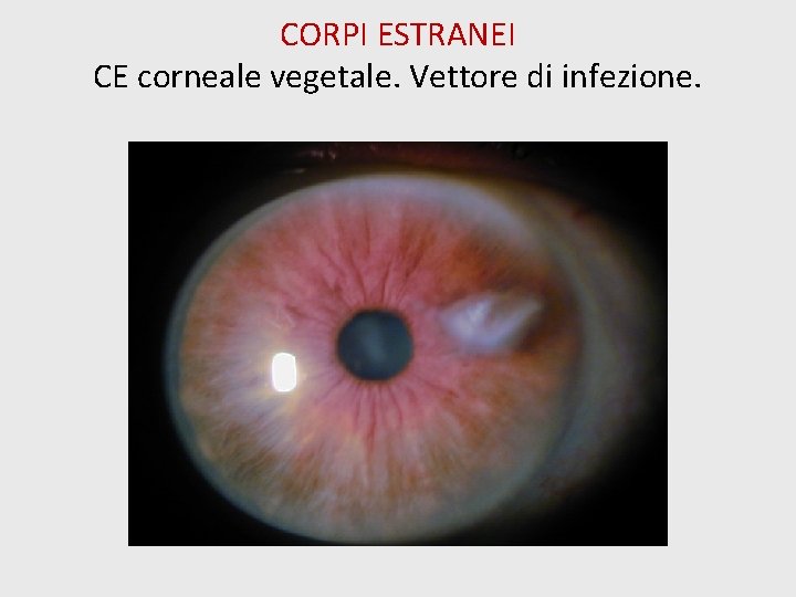 CORPI ESTRANEI CE corneale vegetale. Vettore di infezione. 