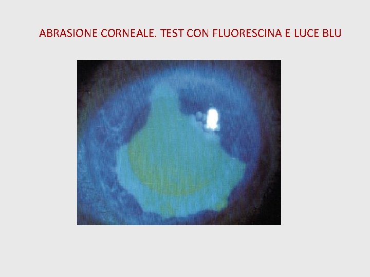 ABRASIONE CORNEALE. TEST CON FLUORESCINA E LUCE BLU 