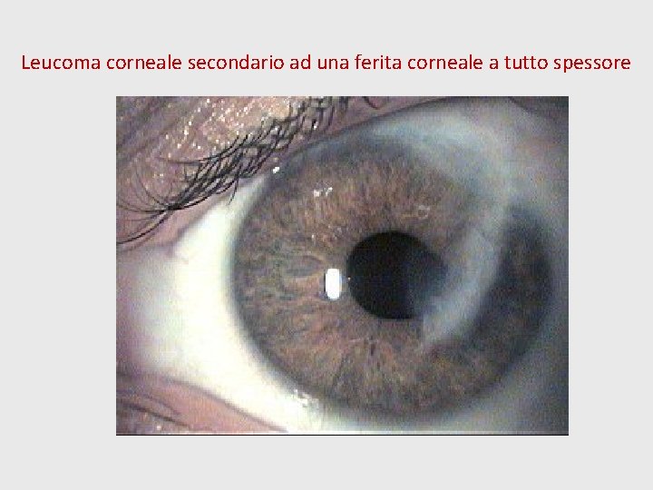 Leucoma corneale secondario ad una ferita corneale a tutto spessore 