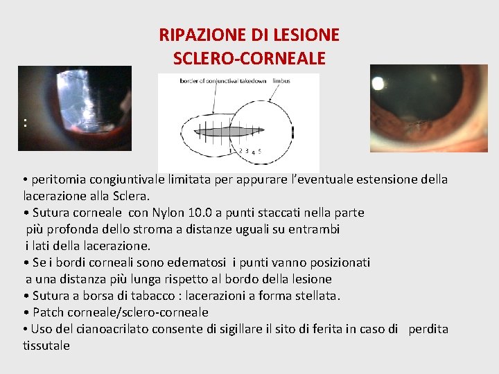 RIPAZIONE DI LESIONE SCLERO-CORNEALE : • peritomia congiuntivale limitata per appurare l’eventuale estensione della