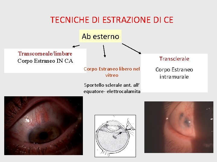 TECNICHE DI ESTRAZIONE DI CE Ab esterno Transcorneale/limbare Corpo Estraneo IN CA Transclerale Corpo