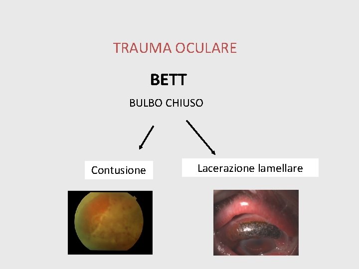 TRAUMA OCULARE BETT BULBO CHIUSO Contusione Lacerazione lamellare 