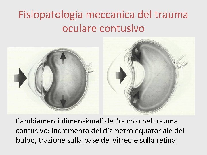 Fisiopatologia meccanica del trauma oculare contusivo Cambiamenti dimensionali dell’occhio nel trauma contusivo: incremento del