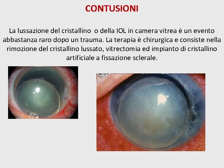 CONTUSIONI La lussazione del cristallino o della IOL in camera vitrea è un evento