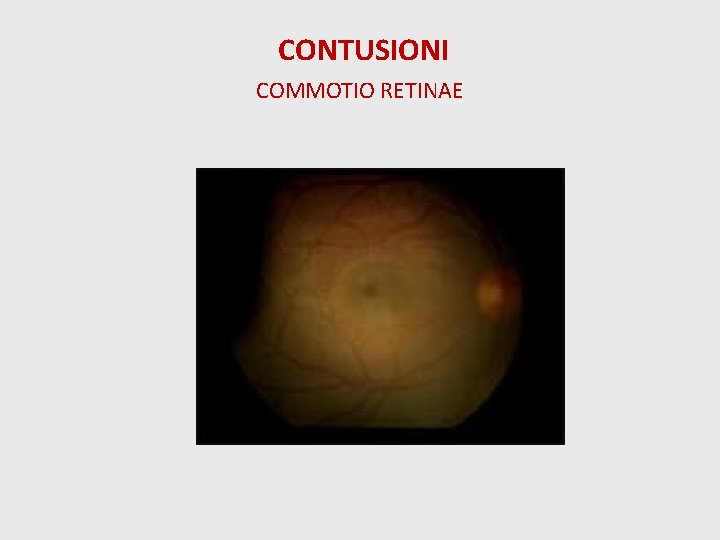 CONTUSIONI COMMOTIO RETINAE 