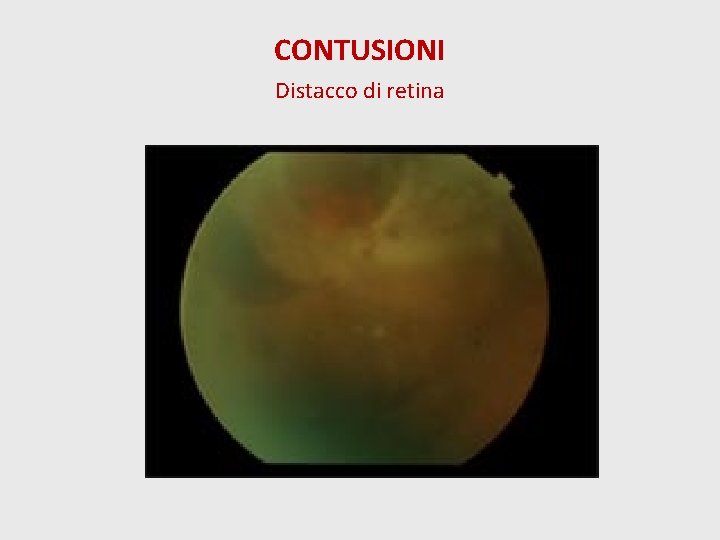 CONTUSIONI Distacco di retina 