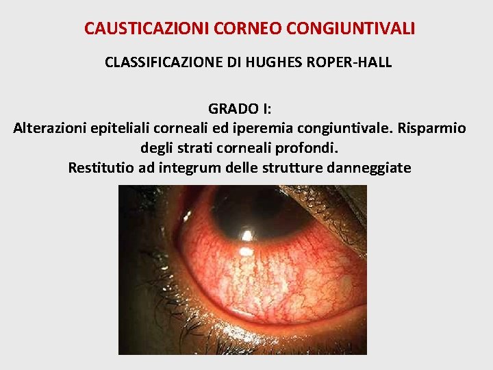 CAUSTICAZIONI CORNEO CONGIUNTIVALI CLASSIFICAZIONE DI HUGHES ROPER-HALL GRADO I: Alterazioni epiteliali corneali ed iperemia