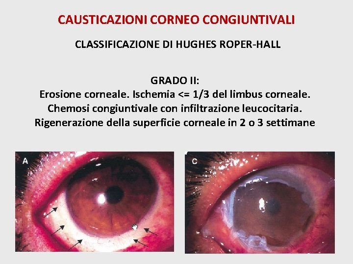 CAUSTICAZIONI CORNEO CONGIUNTIVALI CLASSIFICAZIONE DI HUGHES ROPER-HALL GRADO II: Erosione corneale. Ischemia <= 1/3
