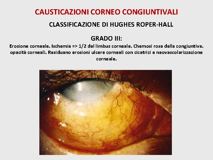 CAUSTICAZIONI CORNEO CONGIUNTIVALI CLASSIFICAZIONE DI HUGHES ROPER-HALL GRADO III: Erosione corneale. Ischemia => 1/2