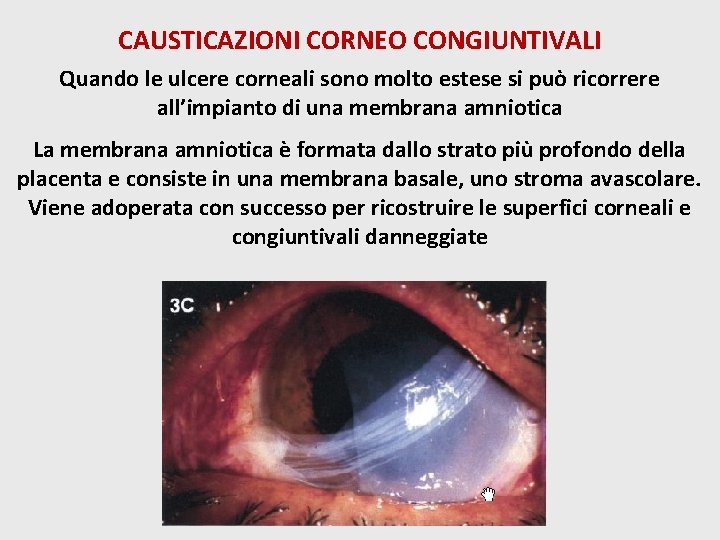 CAUSTICAZIONI CORNEO CONGIUNTIVALI Quando le ulcere corneali sono molto estese si può ricorrere all’impianto