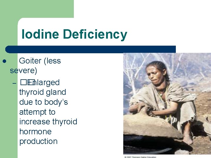 Iodine Deficiency l Goiter (less severe) – �� Enlarged thyroid gland due to body’s