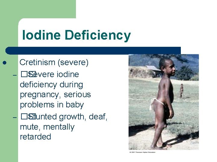Iodine Deficiency l – – Cretinism (severe) �� Severe iodine deficiency during pregnancy, serious
