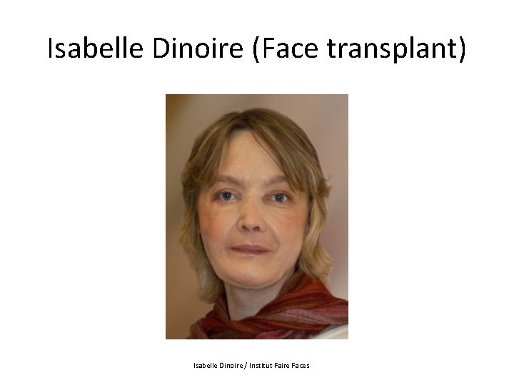 Isabelle Dinoire (Face transplant) Isabelle Dinoire / Institut Faire Faces 