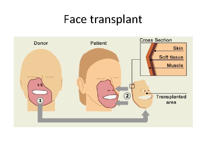 Face transplant 
