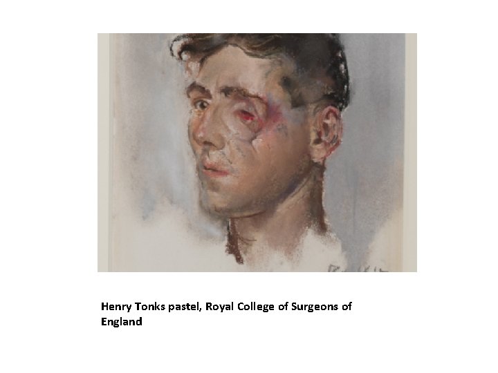 Henry Tonks pastel, Royal College of Surgeons of England 