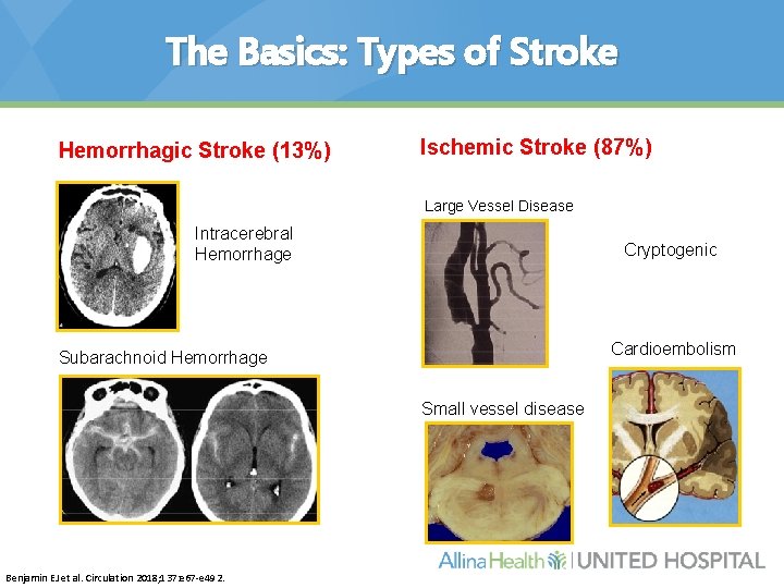 The Basics: Types of Stroke Hemorrhagic Stroke (13%) Ischemic Stroke (87%) Large Vessel Disease