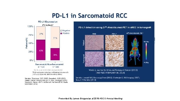 PD-L 1 in Sarcomatoid RCC Presented By James Brugarolas at 2019 ASCO Annual Meeting