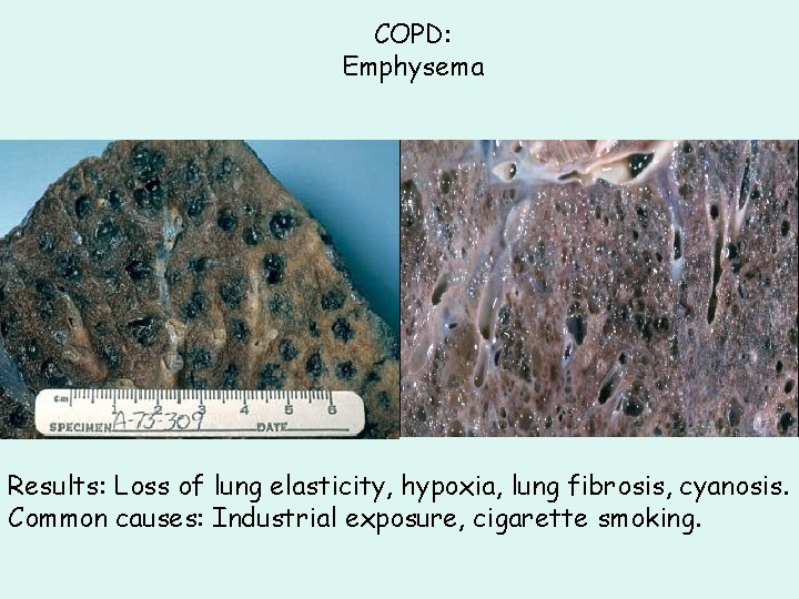 COPD: Emphysema Results: Loss of lung elasticity, hypoxia, lung fibrosis, cyanosis. Common causes: Industrial COPD: Emphysema Results: Loss of lung elasticity, hypoxia, lung fibrosis, cyanosis. Common causes: Industrial