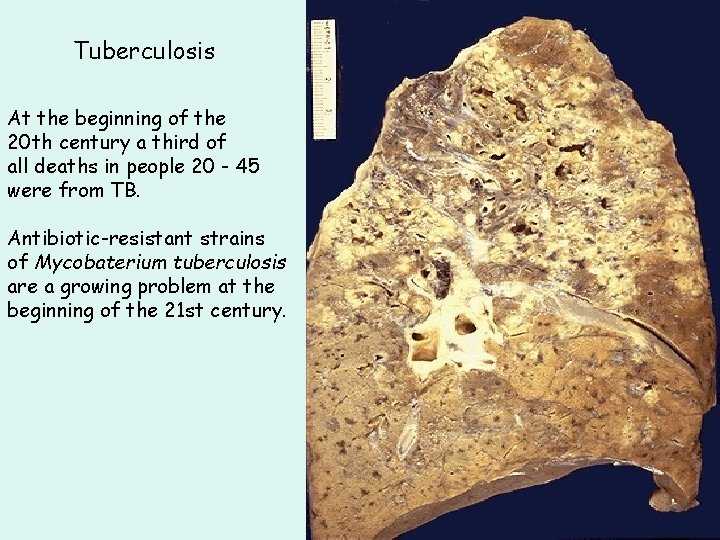 Tuberculosis At the beginning of the 20 th century a third of all deaths Tuberculosis At the beginning of the 20 th century a third of all deaths