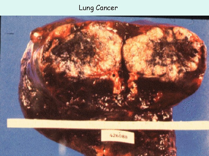 Lung Cancer Lung Cancer