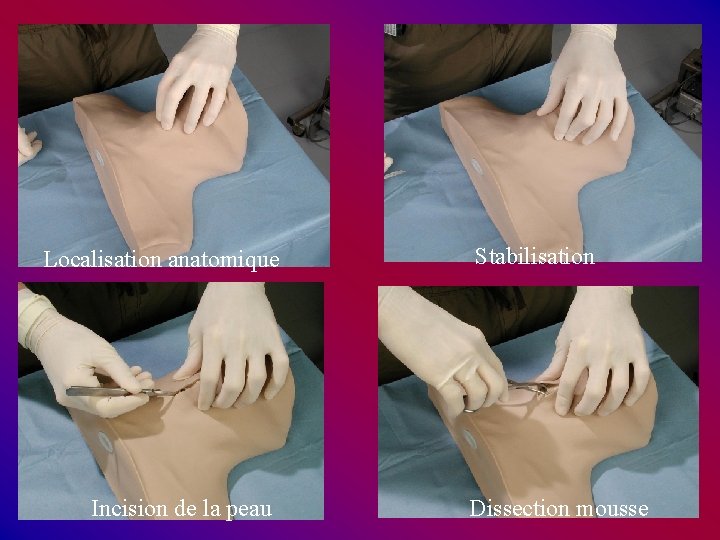 Localisation anatomique Incision de la peau Stabilisation Dissection mousse Localisation anatomique Incision de la peau Stabilisation Dissection mousse