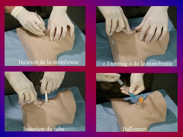 Incision de la membrane Insertion du tube « Stenting » de la membrane Ballonnet Incision de la membrane Insertion du tube « Stenting » de la membrane Ballonnet