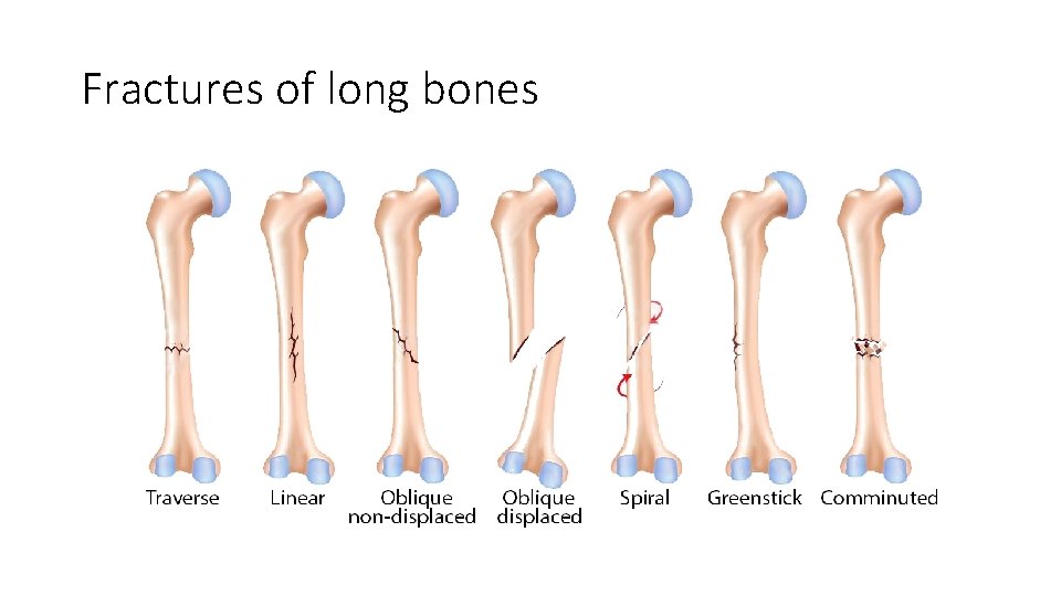Fractures of long bones 
