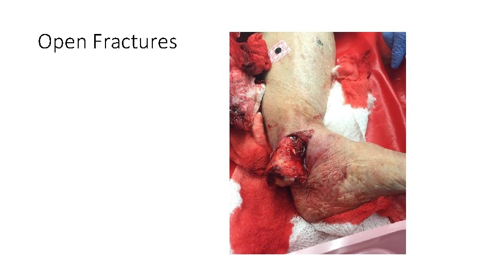 Open Fractures 