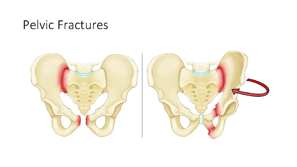 Pelvic Fractures 