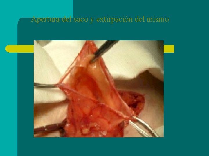 Apertura del saco y extirpación del mismo 