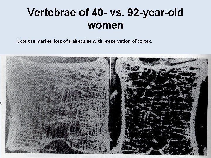 Vertebrae of 40 - vs. 92 -year-old women Note the marked loss of trabeculae