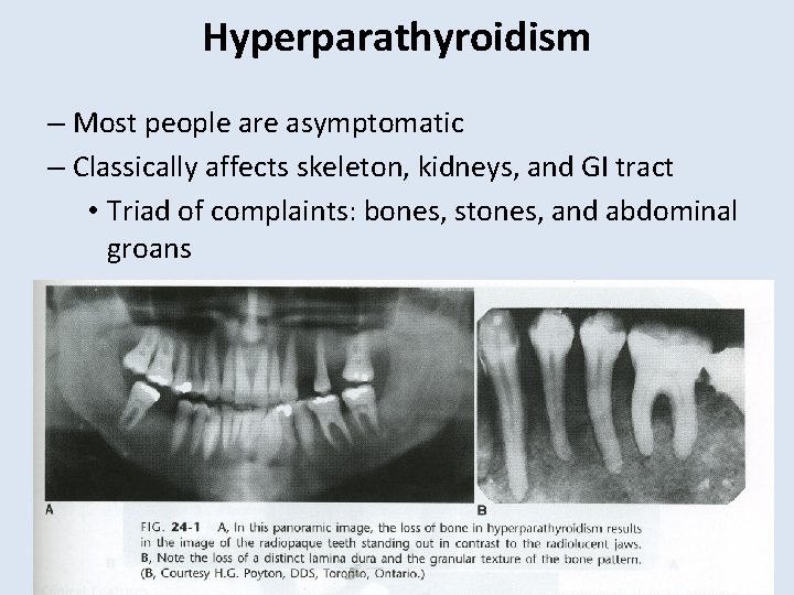 Hyperparathyroidism – Most people are asymptomatic – Classically affects skeleton, kidneys, and GI tract