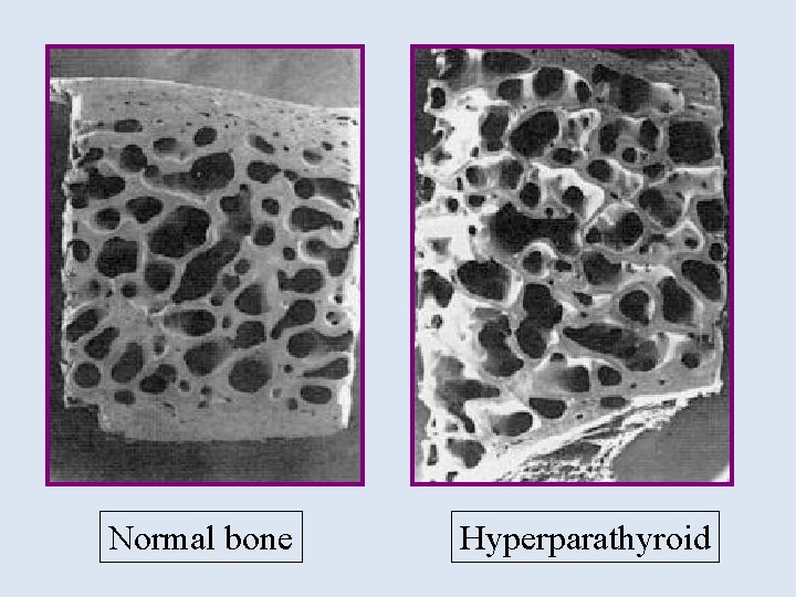 Normal bone Hyperparathyroid 