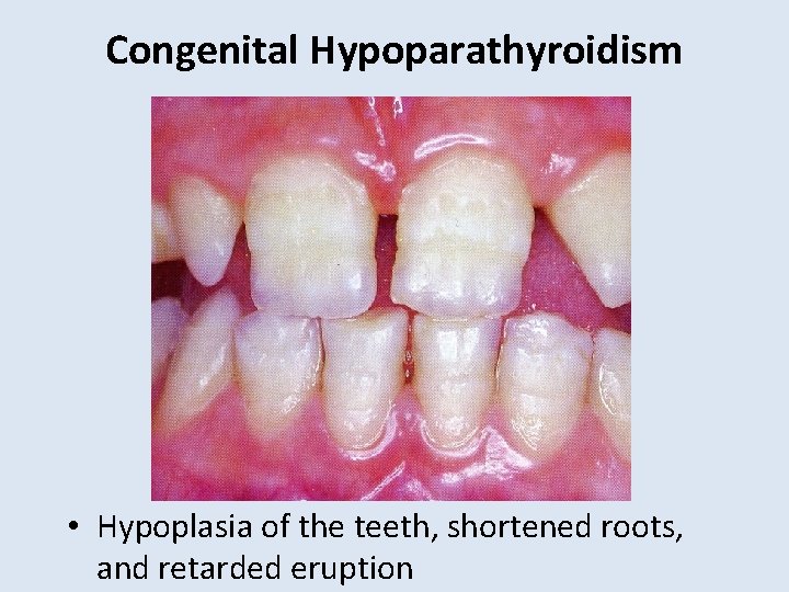 Congenital Hypoparathyroidism • Hypoplasia of the teeth, shortened roots, and retarded eruption 
