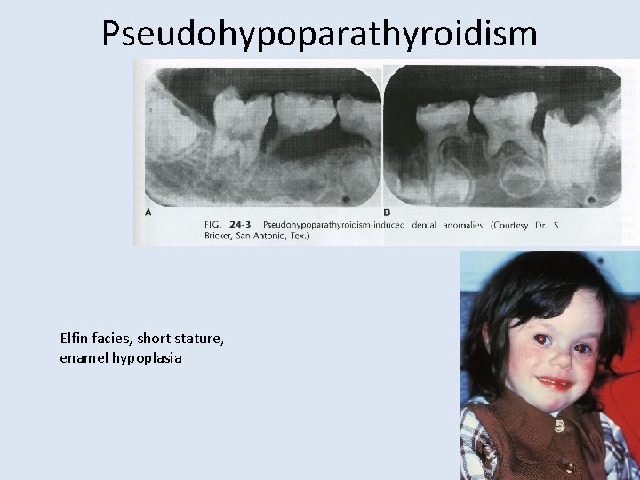Pseudohypoparathyroidism Elfin facies, short stature, enamel hypoplasia 