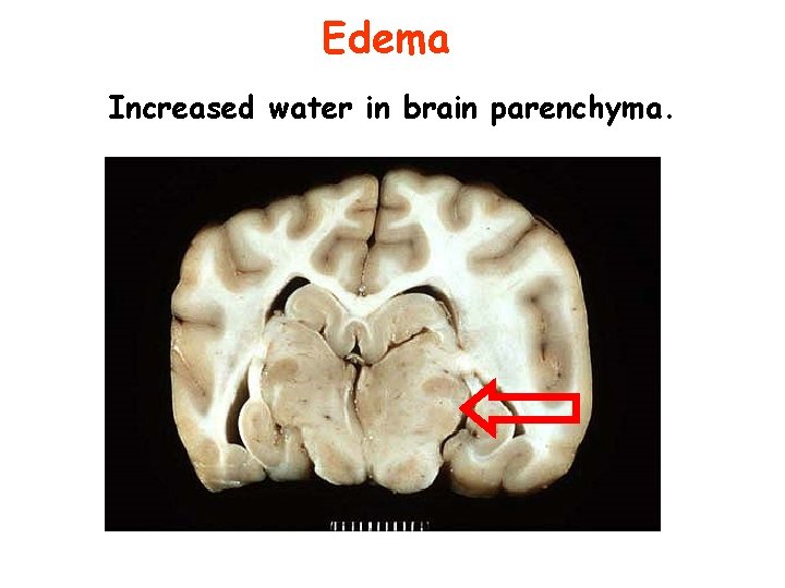 Edema Increased water in brain parenchyma. 