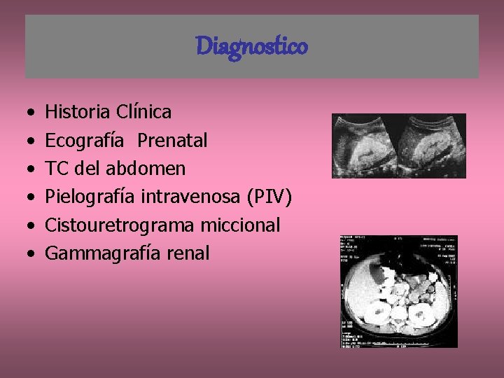 Diagnostico • • • Historia Clínica Ecografía Prenatal TC del abdomen Pielografía intravenosa (PIV)