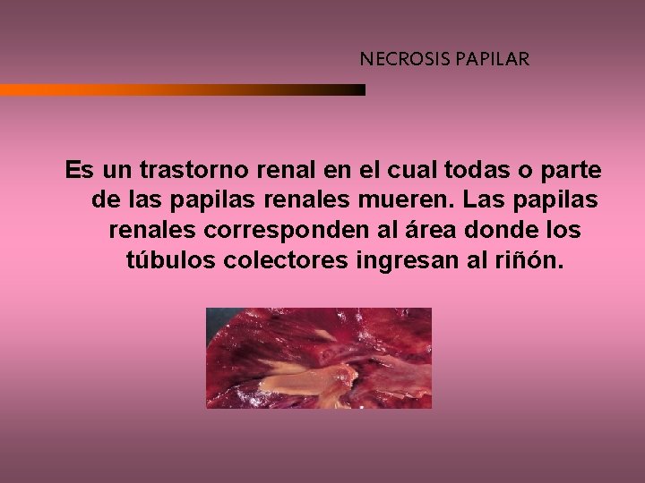 NECROSIS PAPILAR Es un trastorno renal en el cual todas o parte de las
