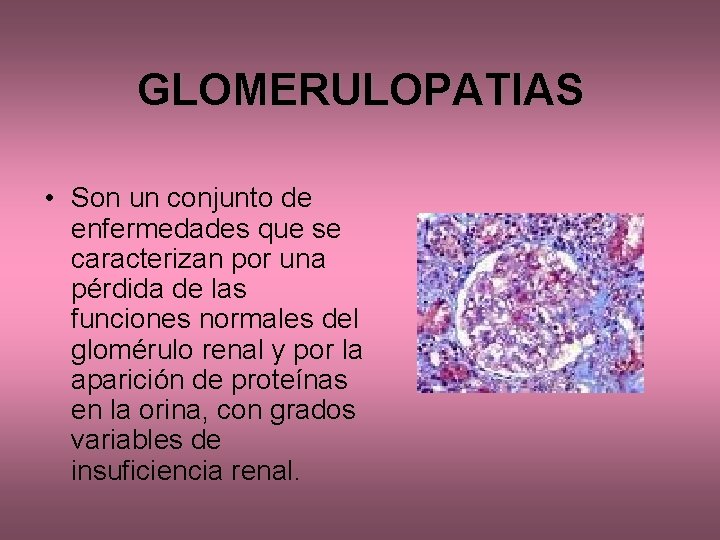 GLOMERULOPATIAS • Son un conjunto de enfermedades que se caracterizan por una pérdida de