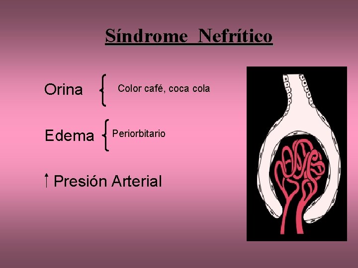 Síndrome Nefrítico Orina Edema Color café, coca cola Periorbitario Presión Arterial 
