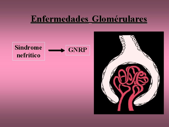 Enfermedades Glomérulares Síndrome nefrítico GNRP 
