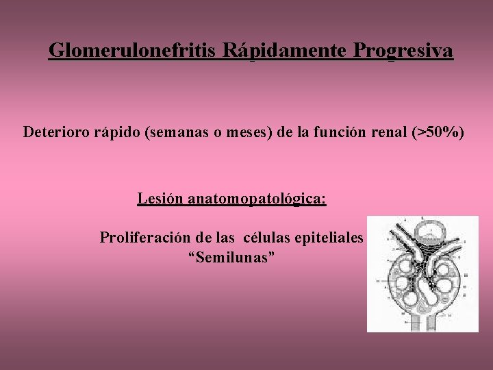 Glomerulonefritis Rápidamente Progresiva Deterioro rápido (semanas o meses) de la función renal (>50%) Lesión