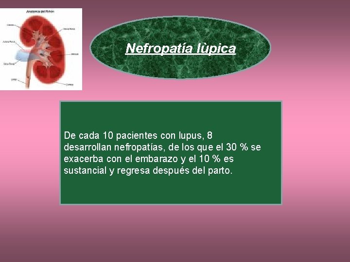 Nefropatía lùpica De cada 10 pacientes con lupus, 8 desarrollan nefropatías, de los que