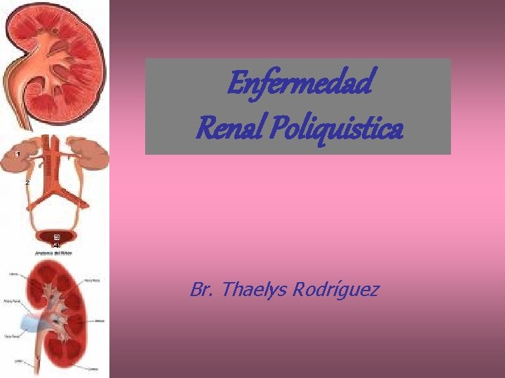 Enfermedad Renal Poliquistica Br. Thaelys Rodríguez 