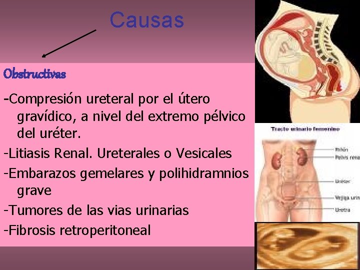 Causas Obstructivas -Compresión ureteral por el útero gravídico, a nivel del extremo pélvico del