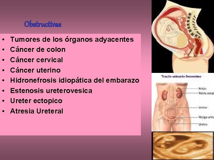 Obstructivas • • Tumores de los órganos adyacentes Cáncer de colon Cáncer cervical Cáncer