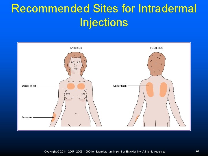 Recommended Sites for Intradermal Injections Copyright © 2011, 2007, 2003, 1999 by Saunders, an