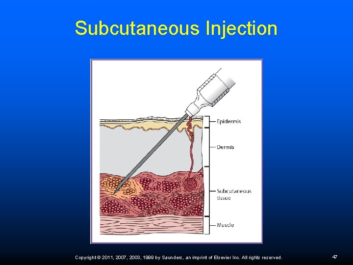 Subcutaneous Injection Copyright © 2011, 2007, 2003, 1999 by Saunders, an imprint of Elsevier